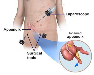 جراحی آپاندیسیت به روش لاپاراسکوپی