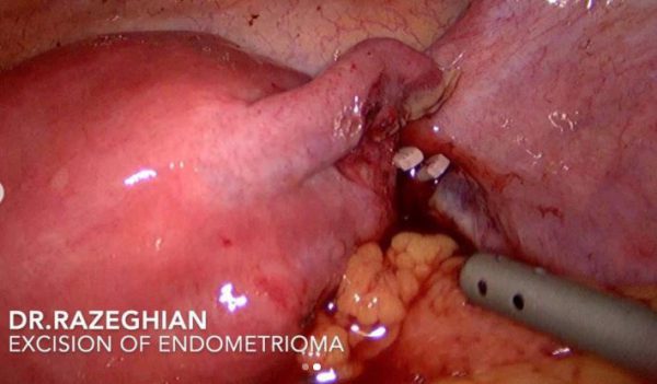 endometrioma