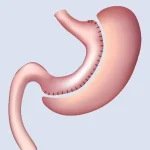 اسلیو معده چیست؟