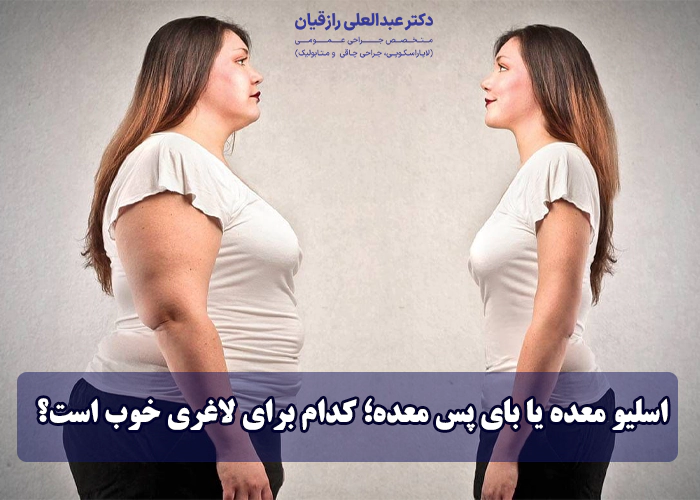 اسلیو معده یا بای پس معده؛ کدام برای لاغری خوب است؟