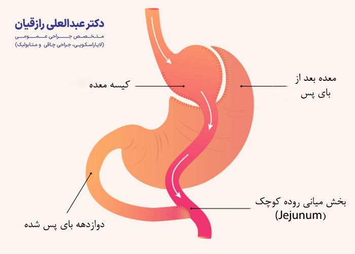 بای پس معده چگونه انجام می شود؟