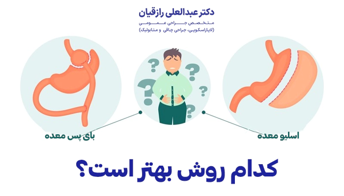بین اسلیو و بای پس معده کدام روش بهتر است؟
