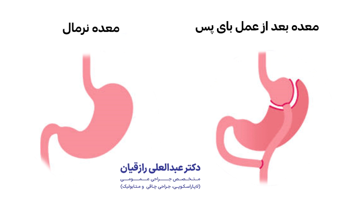 تفاوت معده نرمال و معده بعد از بای پس