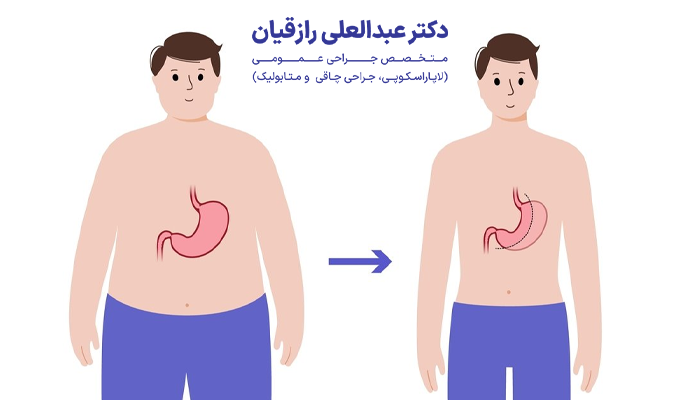 عکس بعد از اسلیو معده