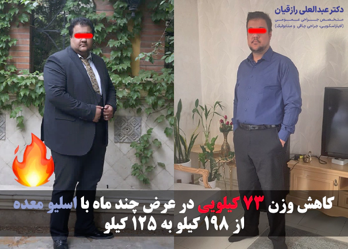 عکس قبل و بعد از اسلیو معده