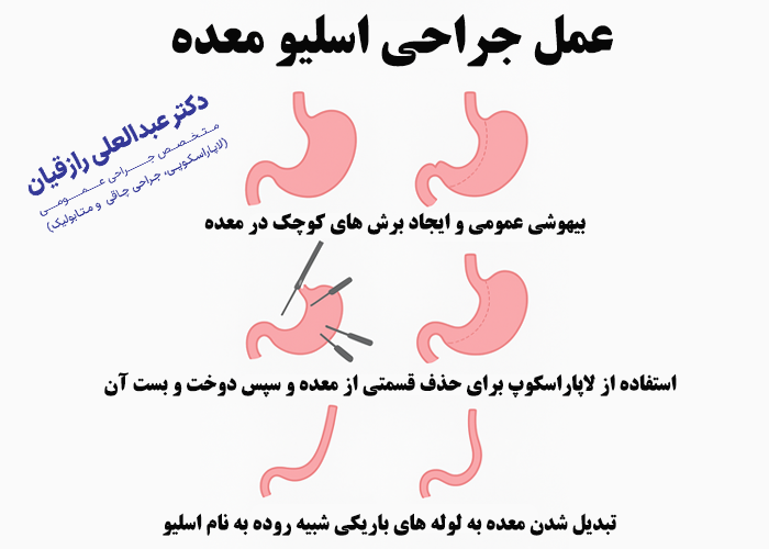 عمل جراحی اسلیو معده چگونه انجام می‌شود؟