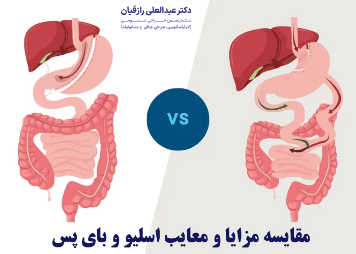 مزایا و معایب اسلیو بای پس معده چیست؟