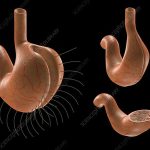 Gastric Plication