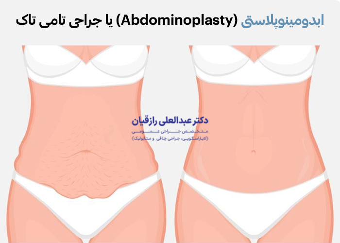 ابدومینوپلاستی چیست و چگونه انجام می شود
