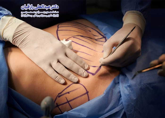 انواع روش های جراحی زیبایی شکم