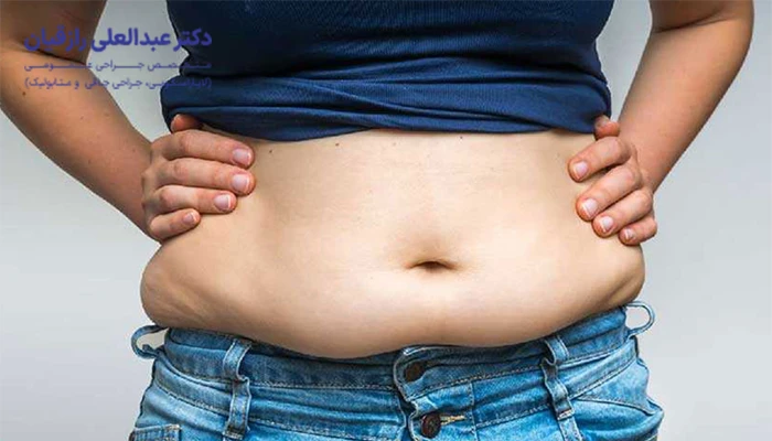 جراحی چاقی برای چه کسانی مناسب است؟