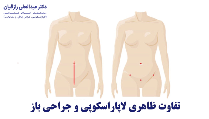 لاپاراسکوپی چه تفاوتی با جراحی باز دارد؟
