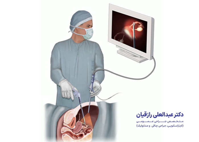 لاپاراسکوپی چگونه انجام میشود؟