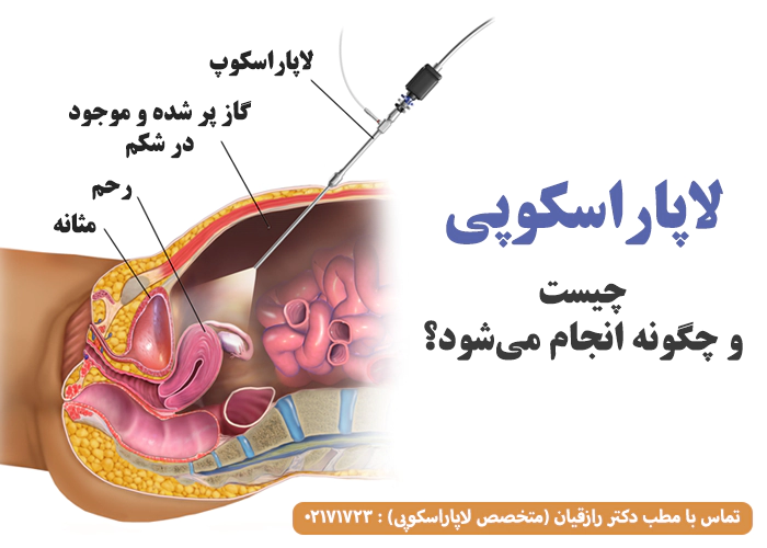 لاپاراسکوپی چیست و چگونه انجام می‌شود؟