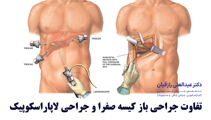 تفاوت جراحی باز و لاپاراسکوپیک برای عمل کیسه صفرا