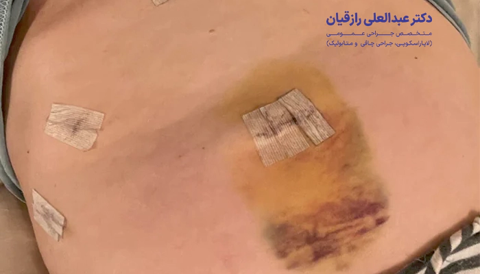 علائم هشدار دهنده بعد از عمل کیسه صفرا