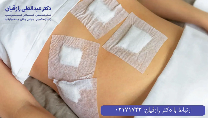 نحوه مراقبت از بخیه و پانسمان بعد از عمل کیسه صفرا