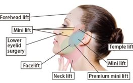 face lift